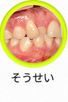 덧니-선택됨