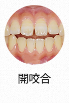 개방교합