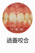과개교합