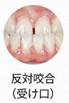 반대교합(주걱턱)