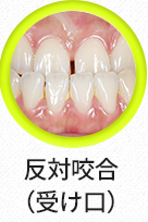 반대교합(주걱턱)-선택됨
