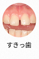 벌어진치아