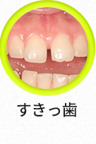벌어진치아-선택됨