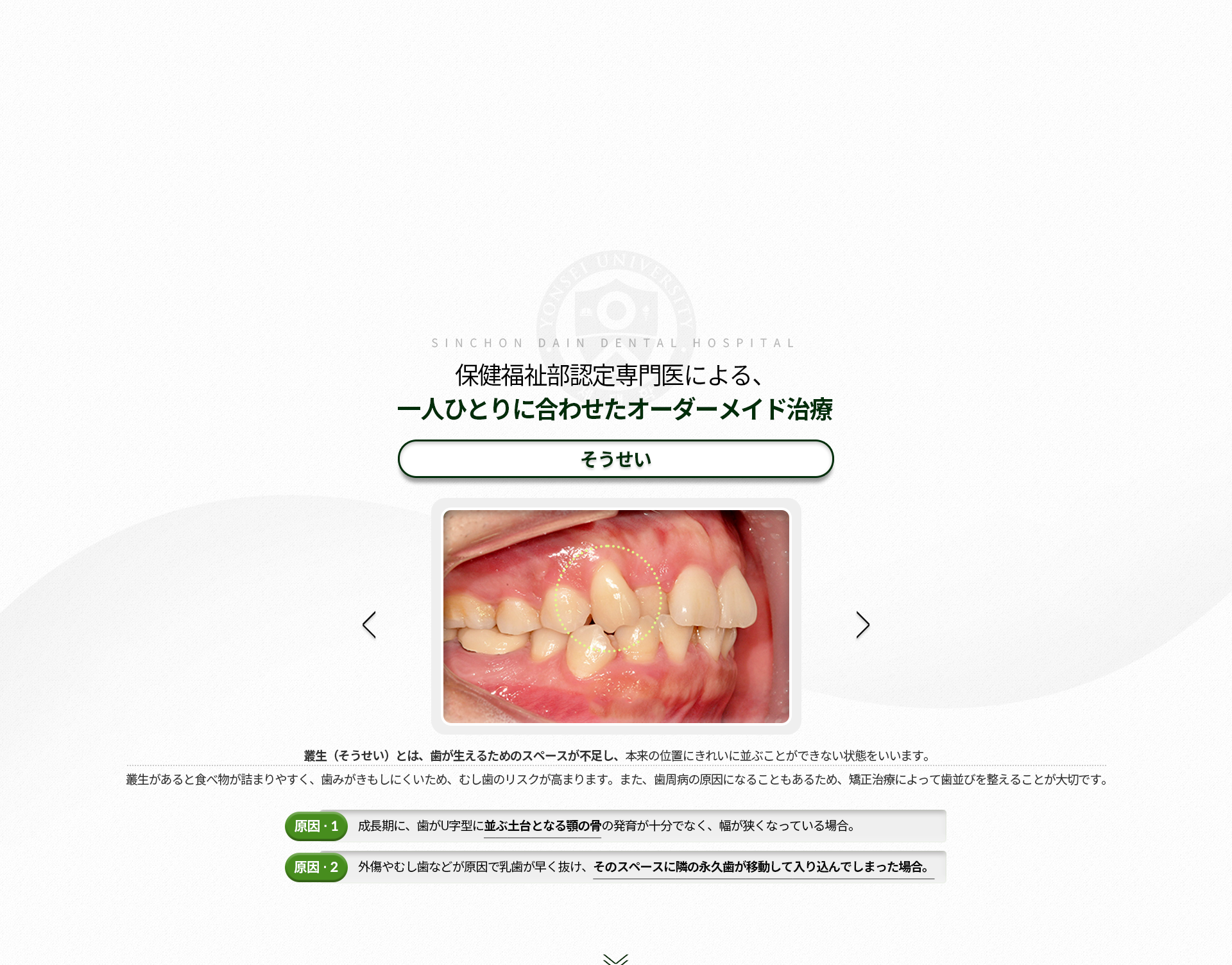 덧니-치아가-올라올-공간이-부족해-제-위치에-올라오지-못하는-상태-음식물이-잘-끼고-칫솔질이-제대로-되지-않아-충치가-생길-위험이-높으며,-치주질환의-원인이-됨-원인1-성장기에-치아가-배열되는-U자형-모양의-잇몸-뼈의-발육이-부진해서-좁아진-경우-원인2-외상이나-충치-등의-이유로-유치가-너무-일찍-빠졌을-때-옆에서-나오고-있던-영구치가-그-자리로-밀고-들어온-경우