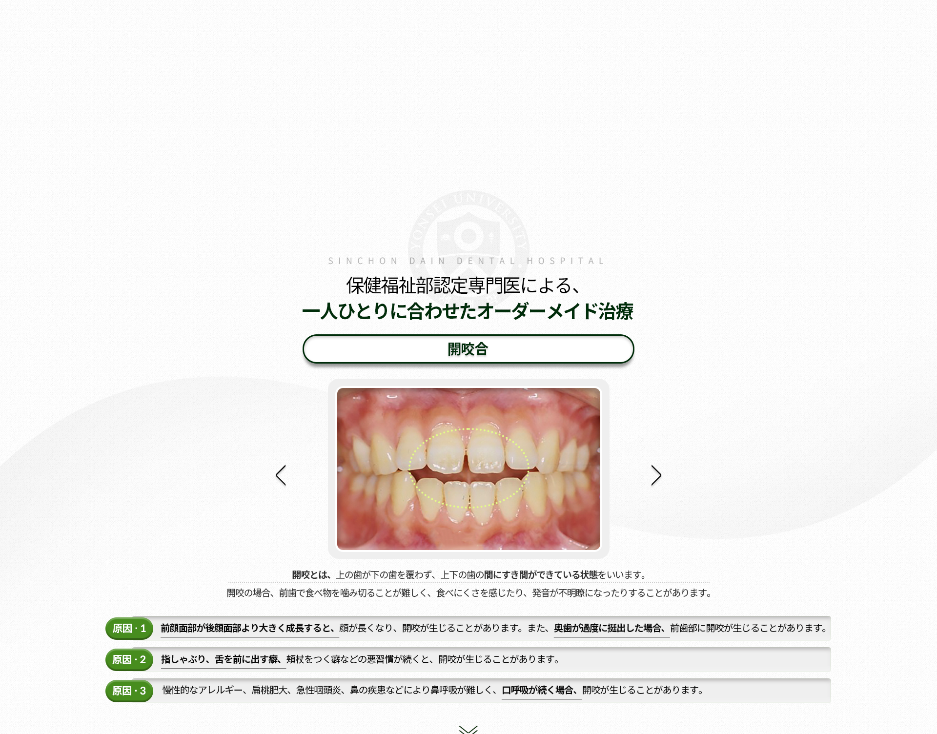 개방교합-윗니가-아랫니를-덮지-못하고-위아래-치아-사이에-틈이-생기는-상태-앞니로-음식물을-자르지-못하고-베어-먹기-힘들고-발음이-새는-증상-원인1-전-안면이-후-안면보다-많이-성장된-경우,-얼굴이-길어지면서-개방교합이-발생,-구치부가-정출된-경우에-전치부가-개방교합이-될-수-있음-원인2-손가락-빨기,-혀내밀기,-턱을-괴는-습관-원인3-만성-알레르기,-편도비대,-급성인후염,-코의-질환으로-인해-코로-숨쉬기-어려워-구호흡을-하는-경우