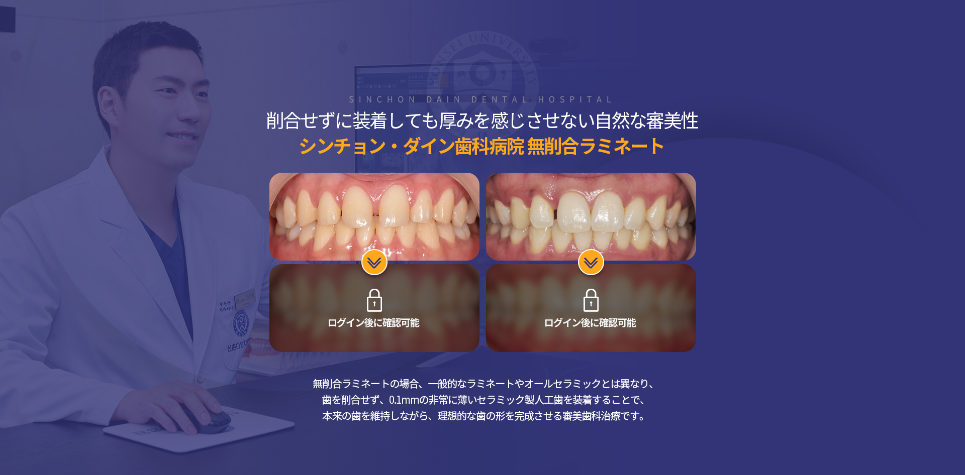삭제-없이-부착해도-두꺼워진-느낌-없이-자연스러운-심미성-무삭제-라미네이트